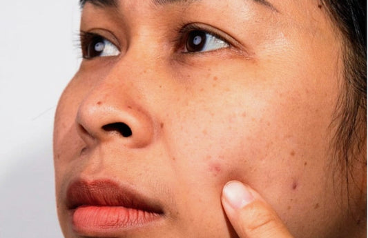 Pores Aren’t Doors: The Architecture of Follicular Management